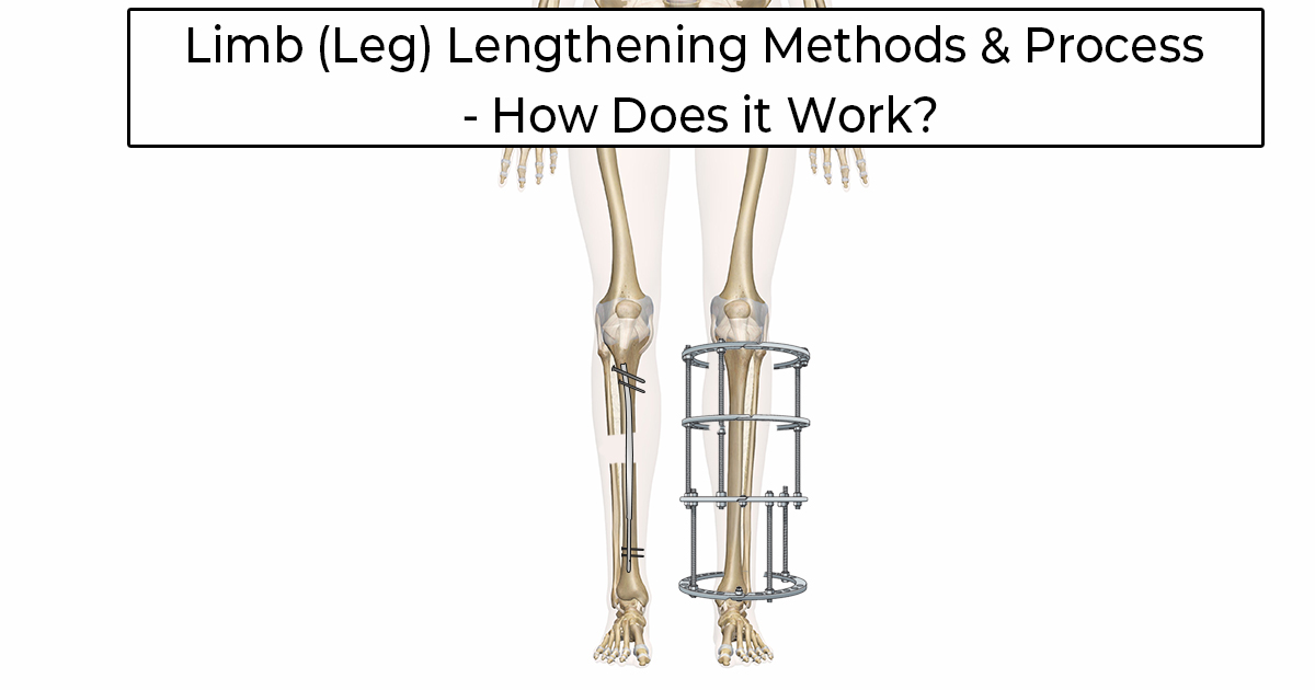 An outline of a patients tibia bones with a circular external fixator on one limb and an intramedullary nail like precice in the medullary cavity on the other leg with the words "Limb (Leg) Lengthening Methods & Process - How Does it Work" at the top of the image.