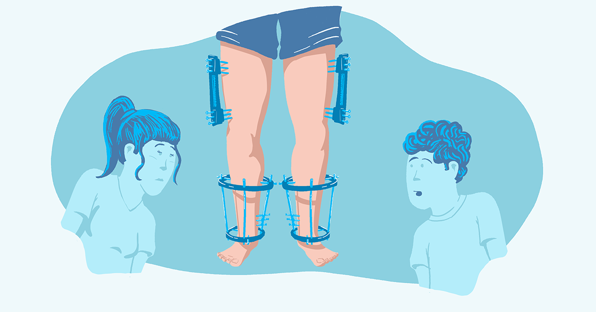 an external ring fixator on the shins of a person and a monorail device on the same persons thights.